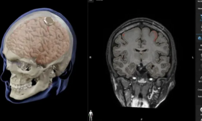 إيلون ماسك يعلن عن نجاح زرع شريحة دماغية في أول إنسان