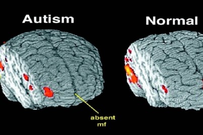 علماء يكتشفون علاقة بين بنية الدماغ ومرض التوحد لدى الأطفال